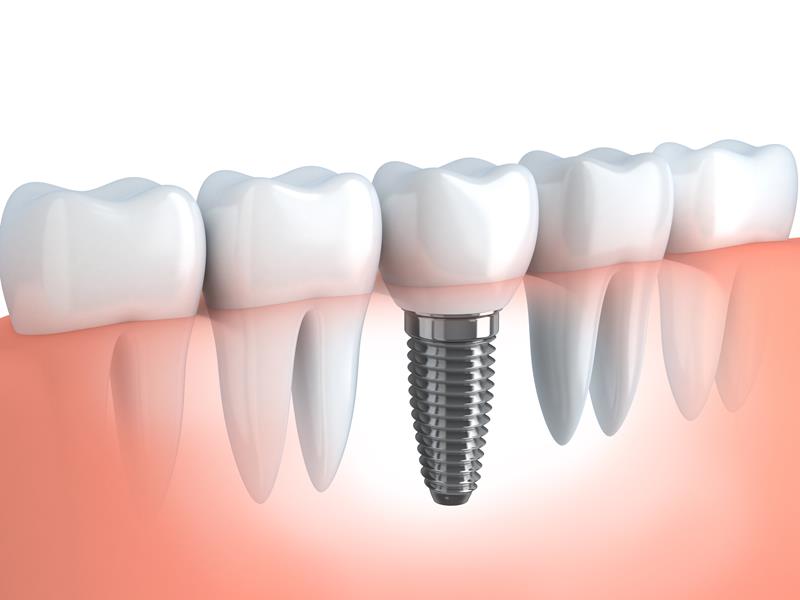 Dental Implants  Virginia Beach, VA