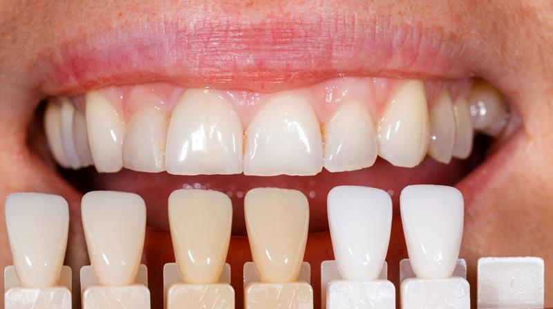 Veneers  Virginia Beach, VA